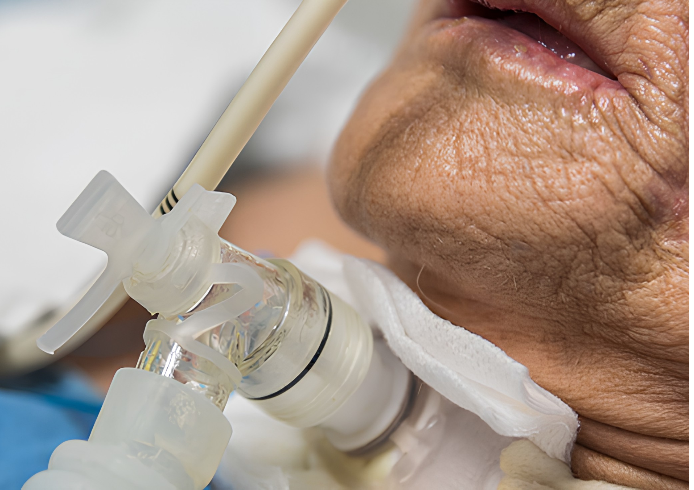 Tracheostomy Care in Asansol with Home Nursing Service and Airway Management Support